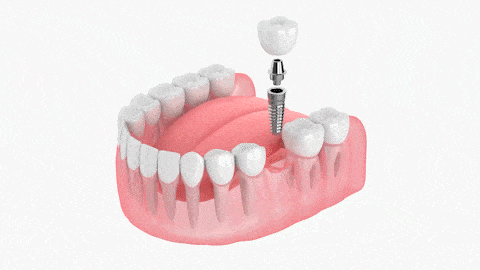 Conventional Dental Implants in Sterling Heights, MI