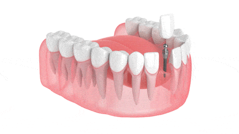 Mini Dental Implants in Sterling Heights, MI | St. Apollonia Dental