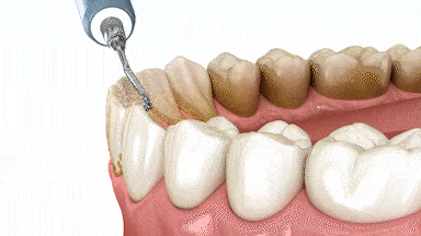 Preventative Dentistry in Sterling Heights, MI