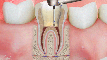 Root Canals in Sterling Heights, MI | St. Apollonia Dental
