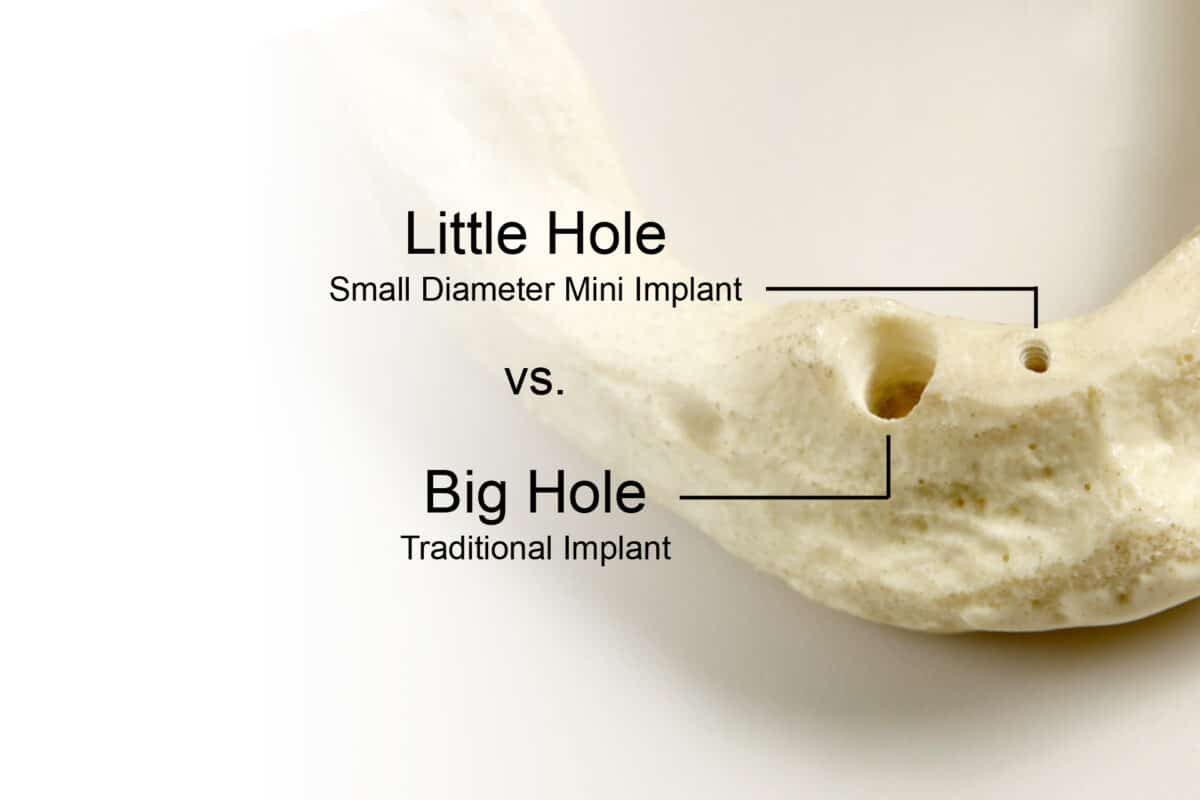 One-Piece-Implants-Redefining-Mini-in-Dental-Implants-Implant-Dentist-in-Sterling-Heights-MI