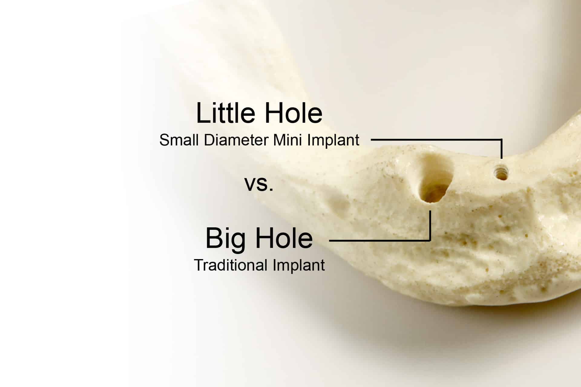 OnePiece Implants Redefining 'Mini' in Dental Implants