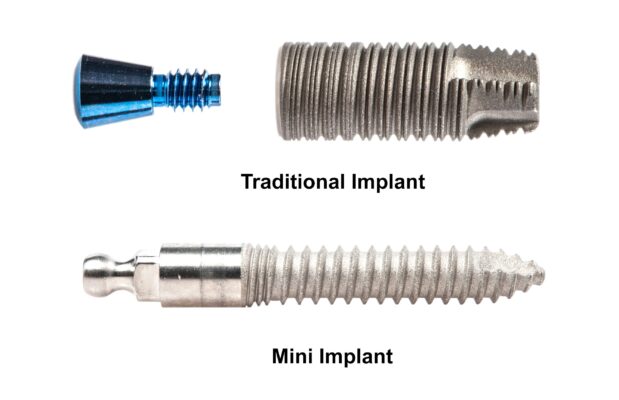 The Advantages of Choosing MINI-mally Invasive Implant Options