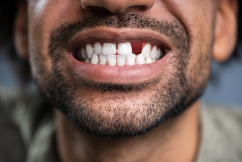 Tooth Loss in Sterling Heights, MI | Mini Dental Implants