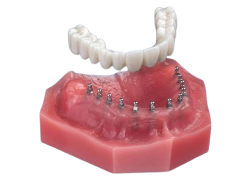 Roundhouse Dental Bridge in Sterling Heights, MI | Implant Denture