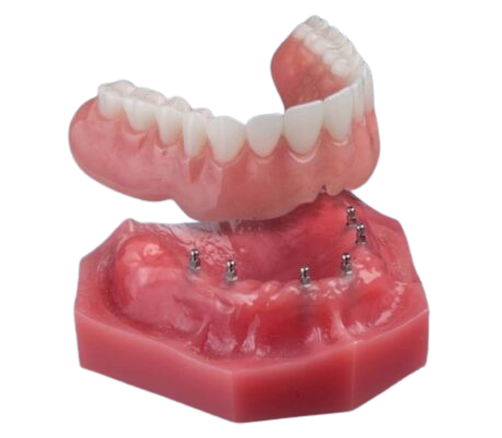 Implant-Supported Dentures in Sterling Heights, MI | Free Consults