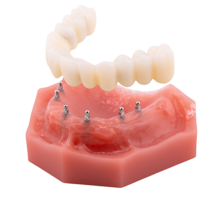 Denture Solutions in Sterling Heights, MI | The Stability of a Roundhouse Bridge