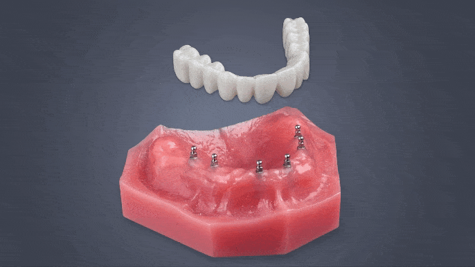 Affordable Implant Dentures in Sterling Heights, MI | Roundhouse Bridges