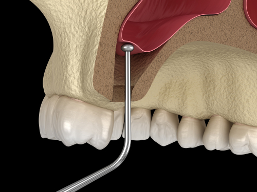 Sinus Lift in Sterling Heights, MI | Book a Free Consultation Today!