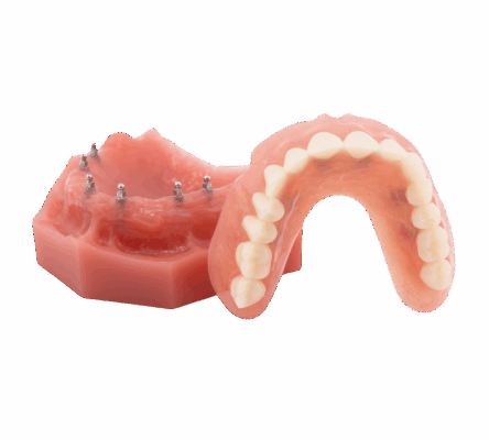 Permanent Implant Dentures in Sterling Heights, MI | Free Consults