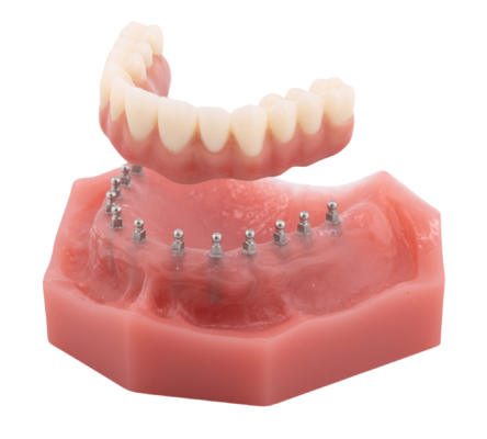 Permanent Implant Dentures in Sterling Heights, MI | Free Consults