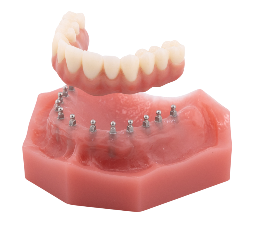 Permanent Implant Dentures in Sterling Heights, MI | Free Consults