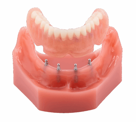 Alternatives to Dentures in Sterling Heights, MI | Secure Your Smile