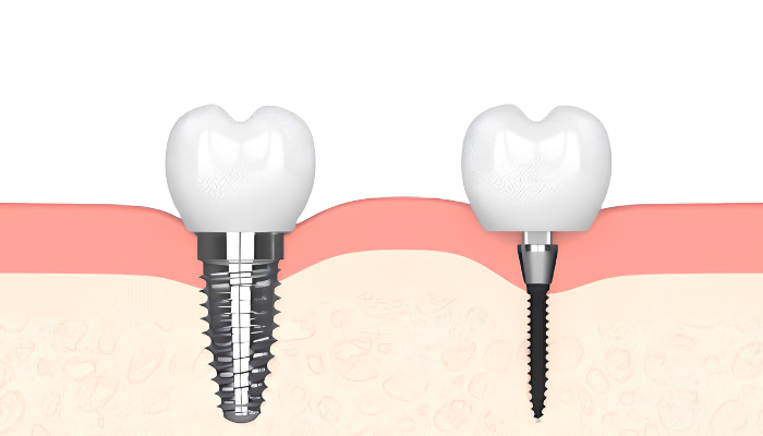 What Is a Mini Dental Implant? | Book a Free Consultation in MI!