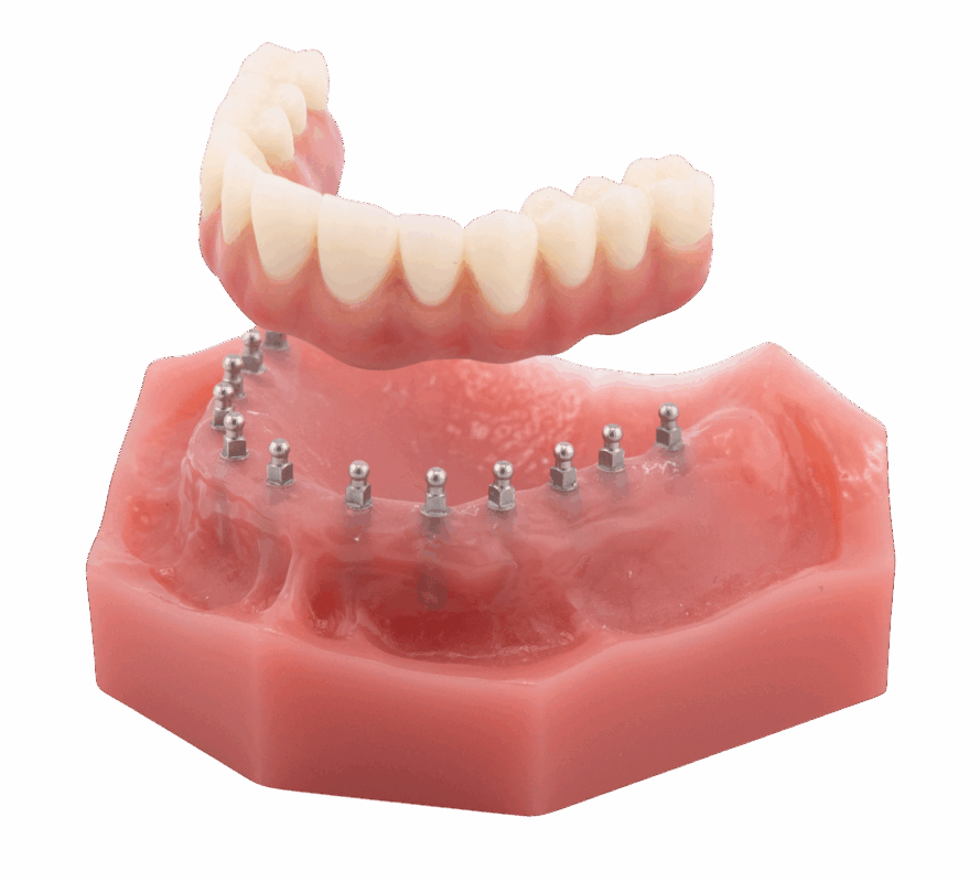 Full Arch Dental Implants in Sterling Heights, MI | Free Consultation