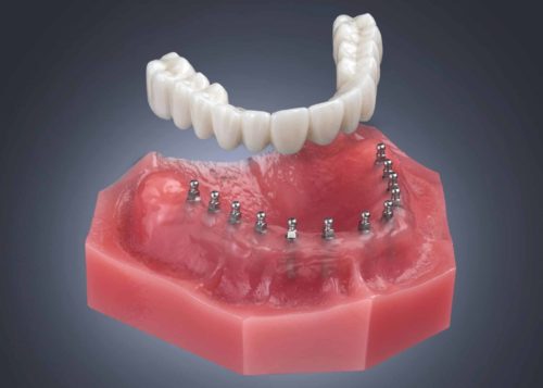 Permanent Denture Implants in Sterling Heights, MI | Free Consults