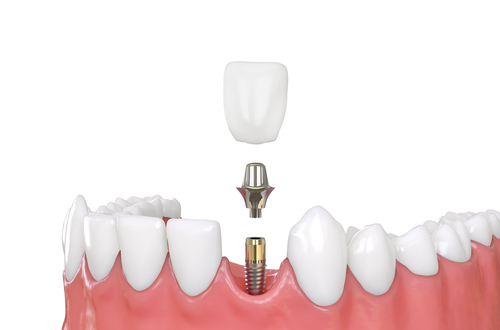 Dental Implants in Sterling Heights, MI | Book a Free Consultation