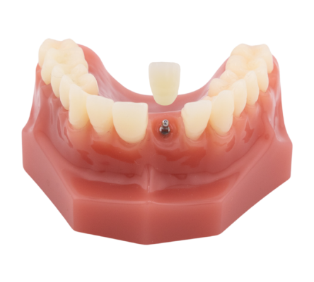 Mini Dental Implant in Sterling Heights, MI | Book a Free Consultation Today