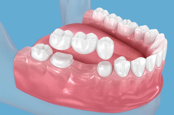 Restorative Dentistry in Sterling Heights, MI | Free Consultations