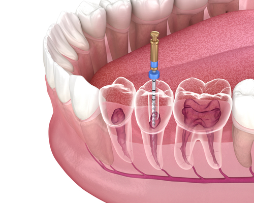 Root Canal Treatment in Sterling Heights, MI | Free Consultations
