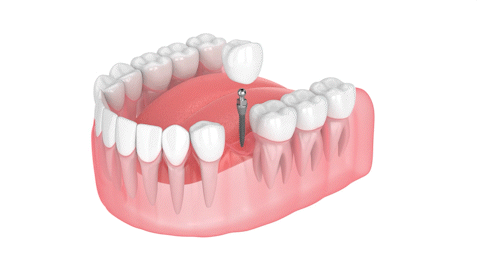 Same-Day Dental Implants in Sterling Heights, MI | One-Piece Mini Dental Implants