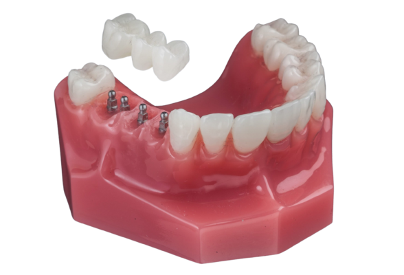 Same-Day Dental Implants in Sterling Heights, MI | Free Consults