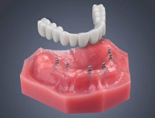 Semi-Permanent Roundhouse Bridge in Sterling Heights, MI | Implant Denture Consult