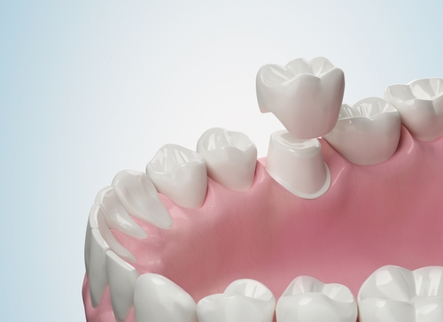Emergency Dentist in Sterling Heights, MI | Dental Crown Treatment