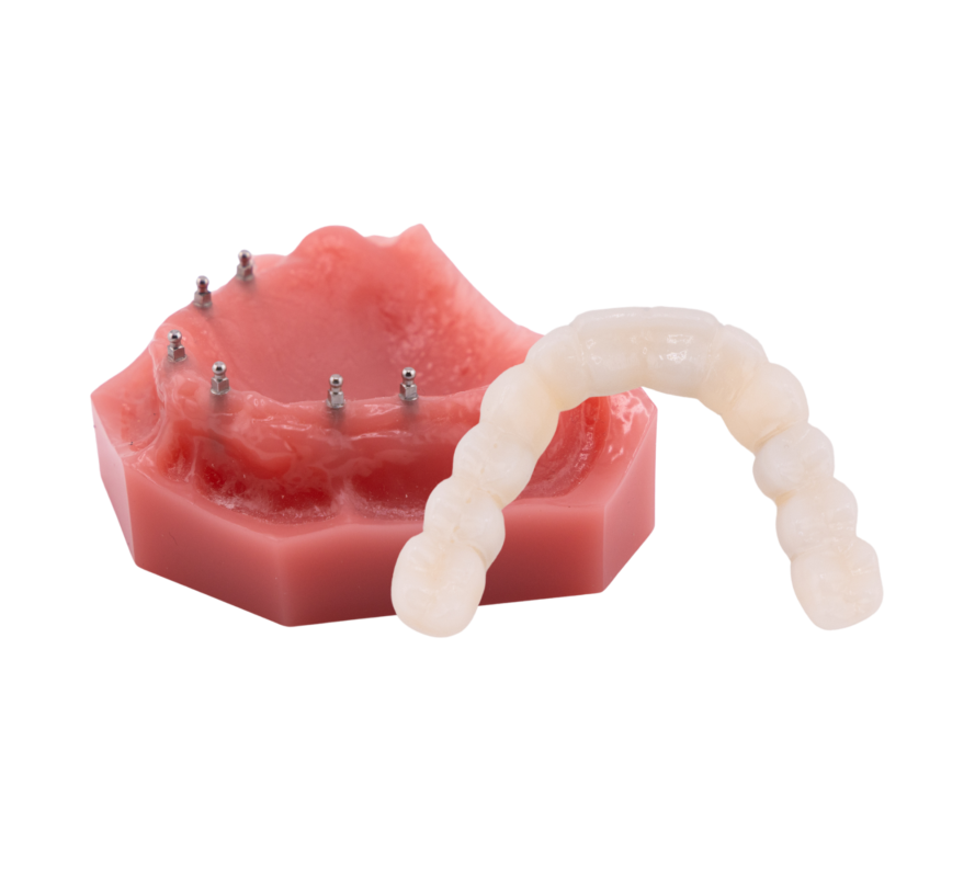 Mini Implants for Dentures [Video Guide] | Free Consultations in MI