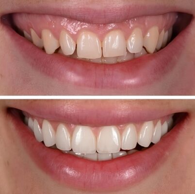 Cost of Veneers [Video FAQs] Free Consultation in Sterling Heights