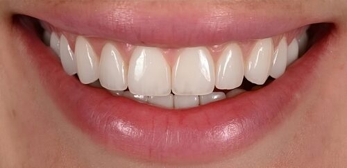 Cost of Veneers [Video FAQs] Free Consultation in Sterling Heights
