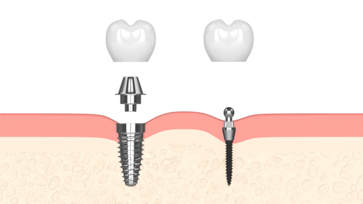 Minimally Invasive Dental Implants [Video Guide] Free Consultation