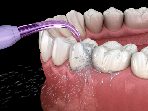 Gum Disease Treatment in Sterling Heights, MI | [Video Inside]
